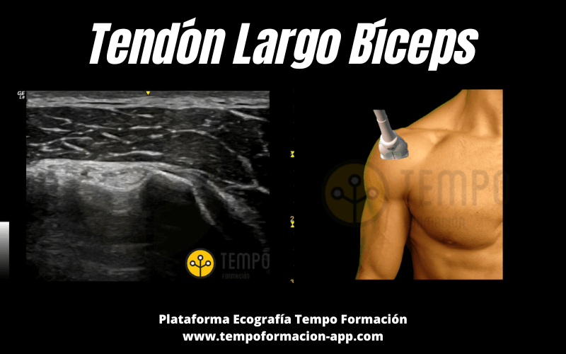 1. Tendon Largo Biceps Ecografia Tempo Formacion.png